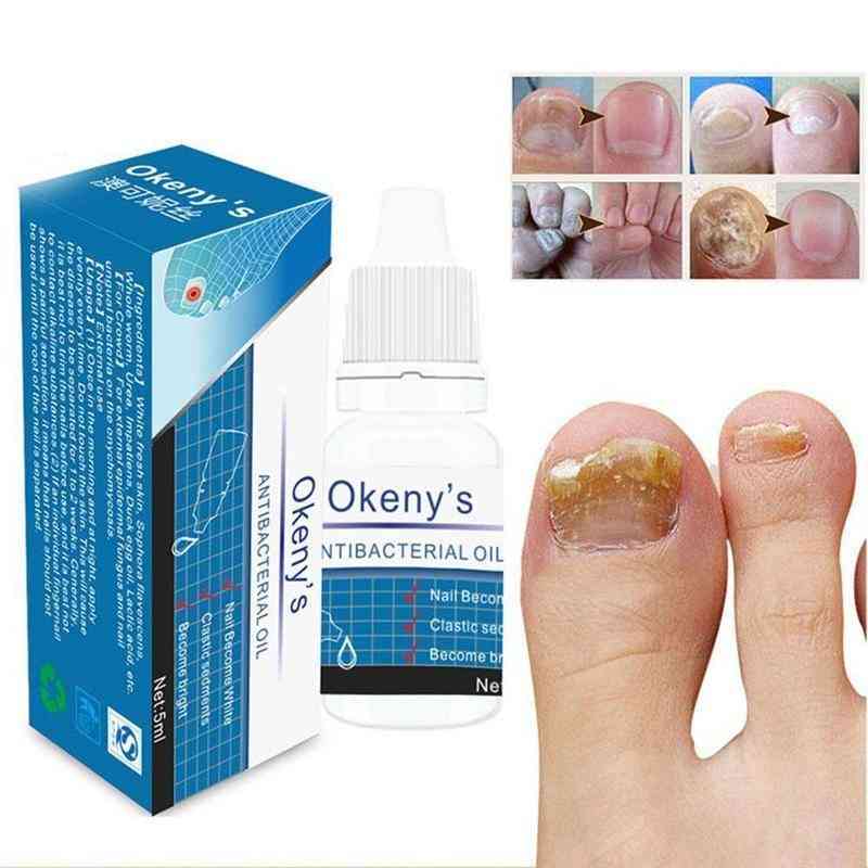 Nail Fungus Treatment With Whitening Toe From Nail Foot Fungus Remove Gel Antifungal Onychomycosis Cream