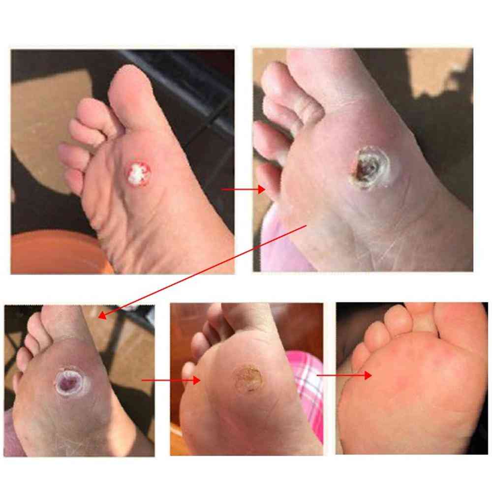 Plastry do usuwania brodawek - bezbolesne stopy, skórki zrogowaciałe, preparat do usuwania odcisków pielęgnacja stóp -