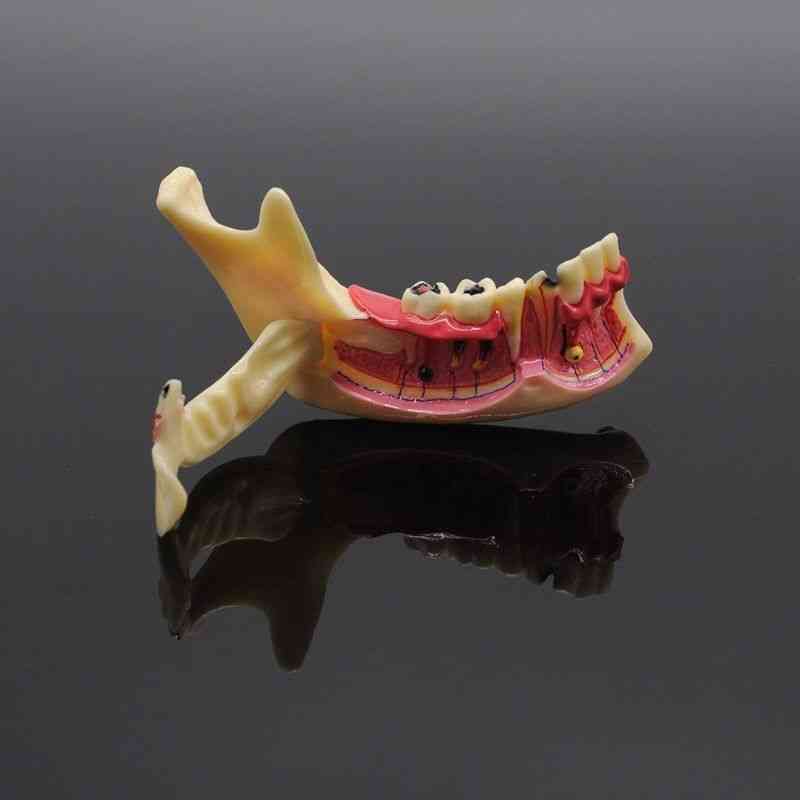 Zahnärztliches endodontisches Behandlungsmodell Anatomie des Zahnfleisches Zahnstudie lehren Zahnmodell