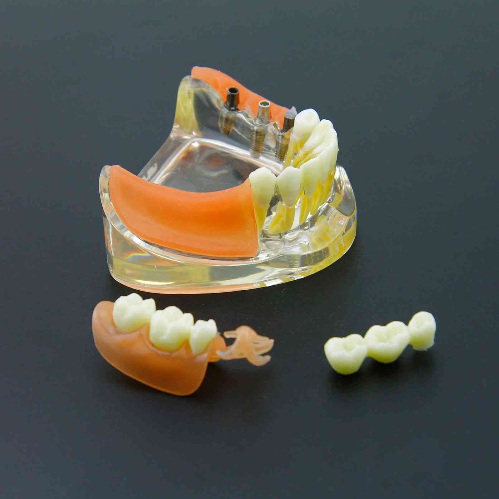 Model zob za obnovo zobnih vsadkov - demo snemljiva mostovna proteza