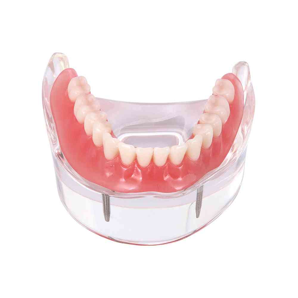 Dental Implant Restoration Teeth Model With Restoration Bridge