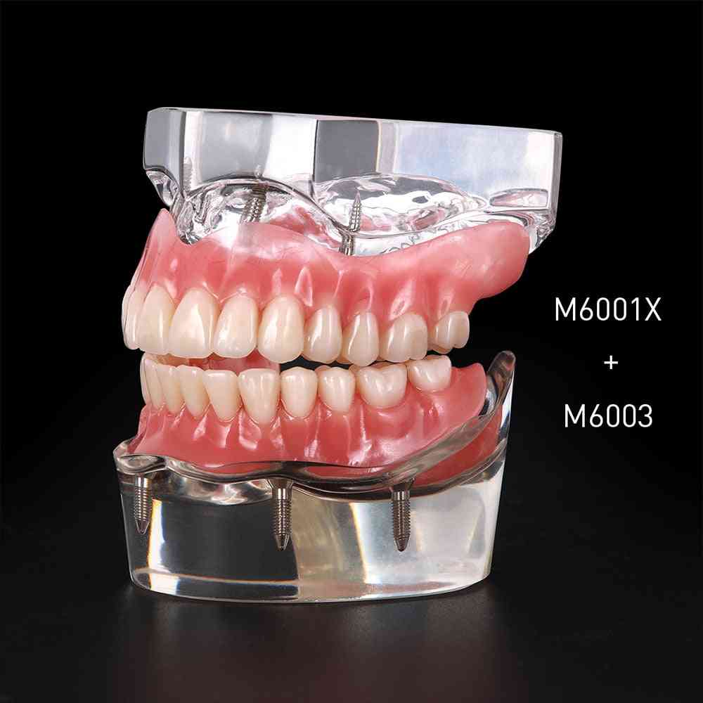 Dental Implant Restoration Teeth Model With Restoration Bridge