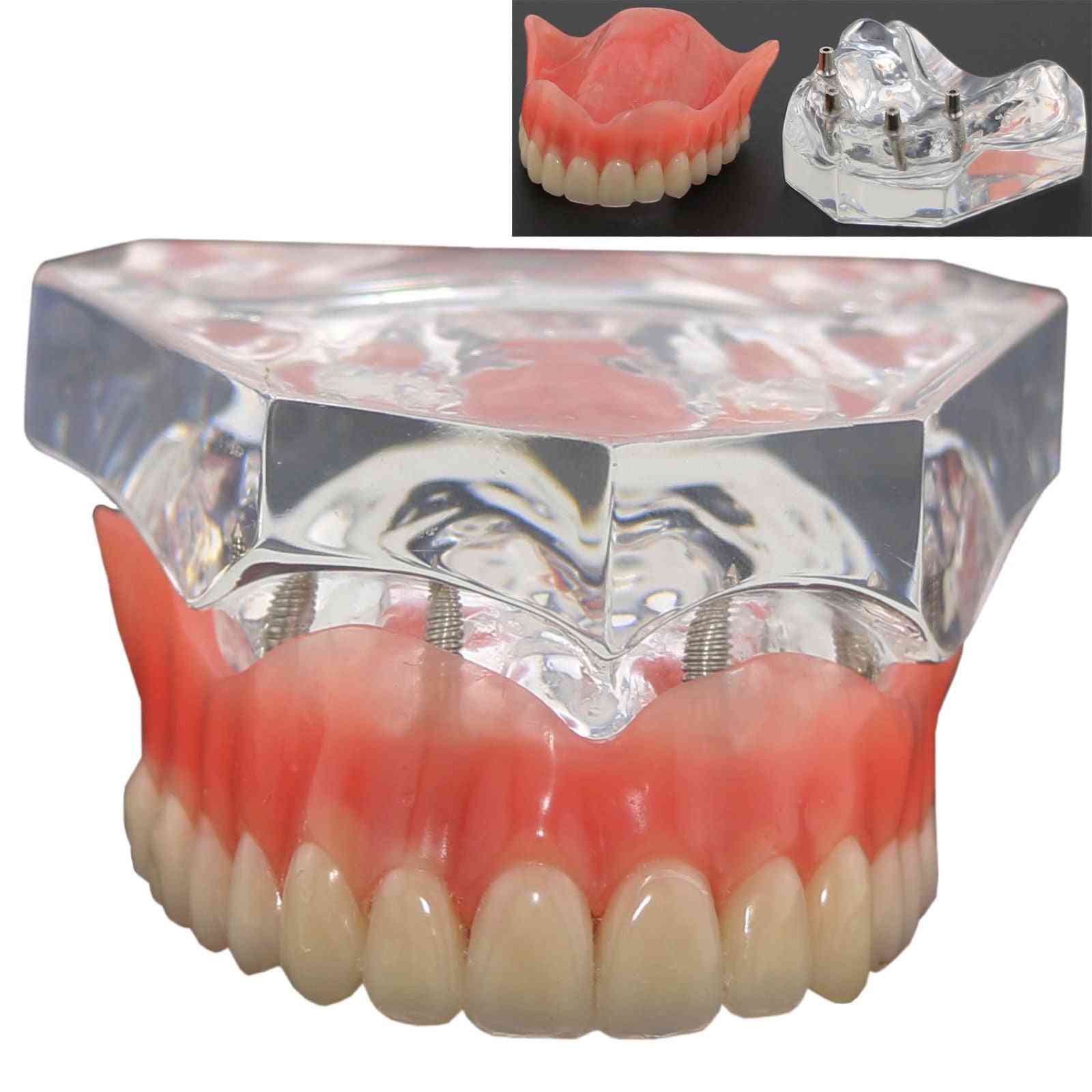 1pcs Dental Upper Overdenture Superior 4 Implants Demo Model, Teeth Model
