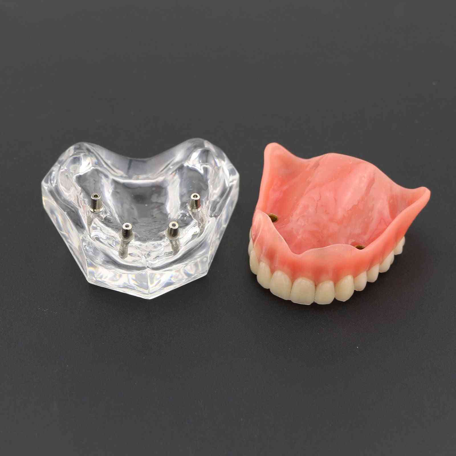 1pcs overdenture dental superior superior 4 implantes modelo de demonstração, modelo de dentes