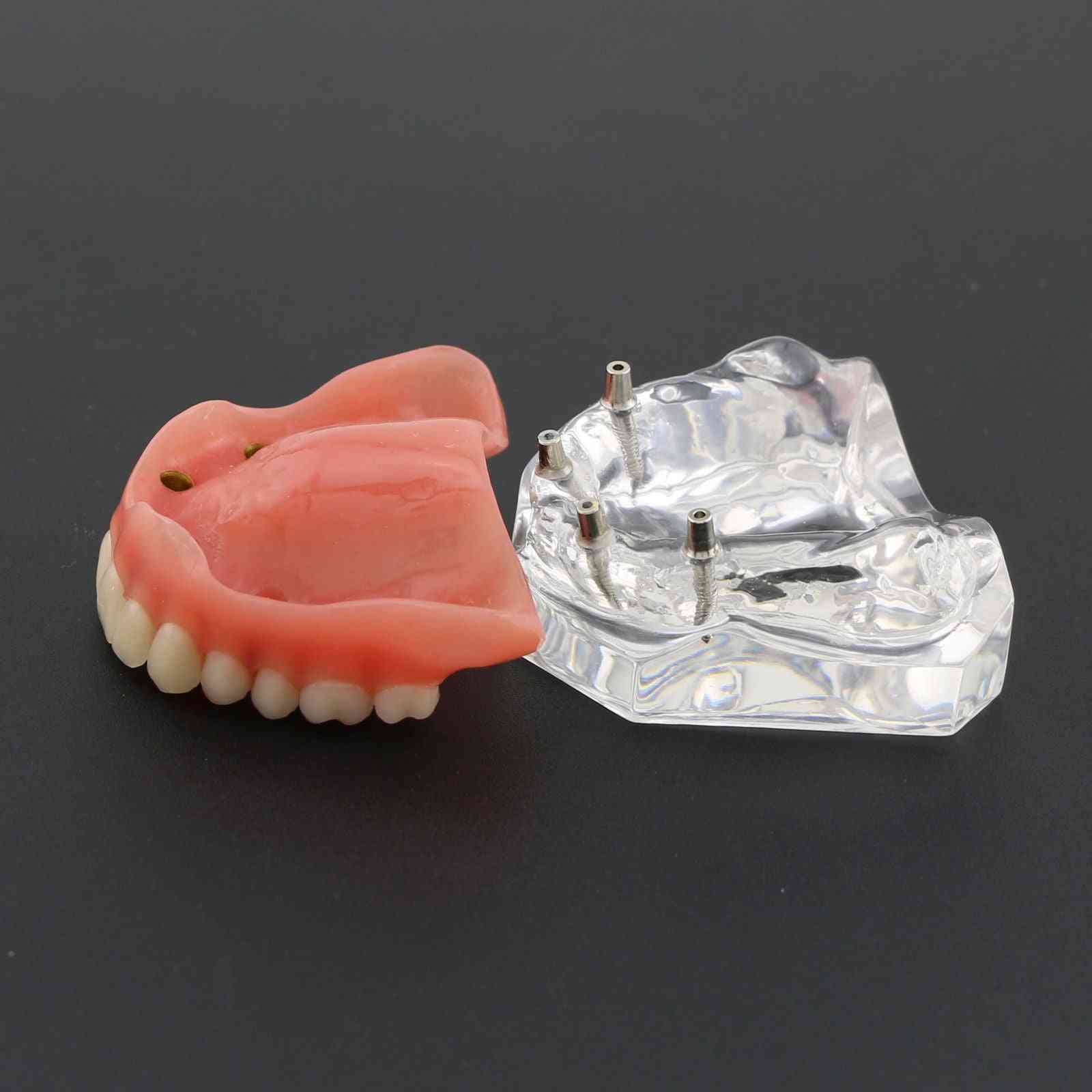 1ks horní zubní overdenture superior 4 implantáty demo model, model zubů