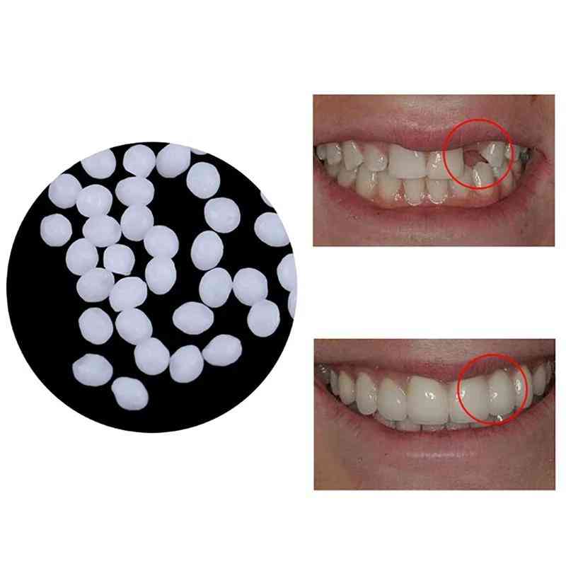 Denti per la riparazione dei denti e set di kit gap