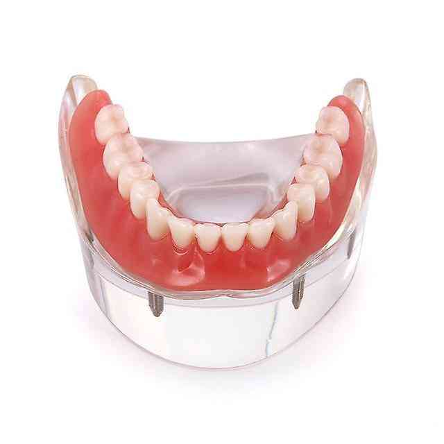 Dental Implant With Restoration Teeth Model