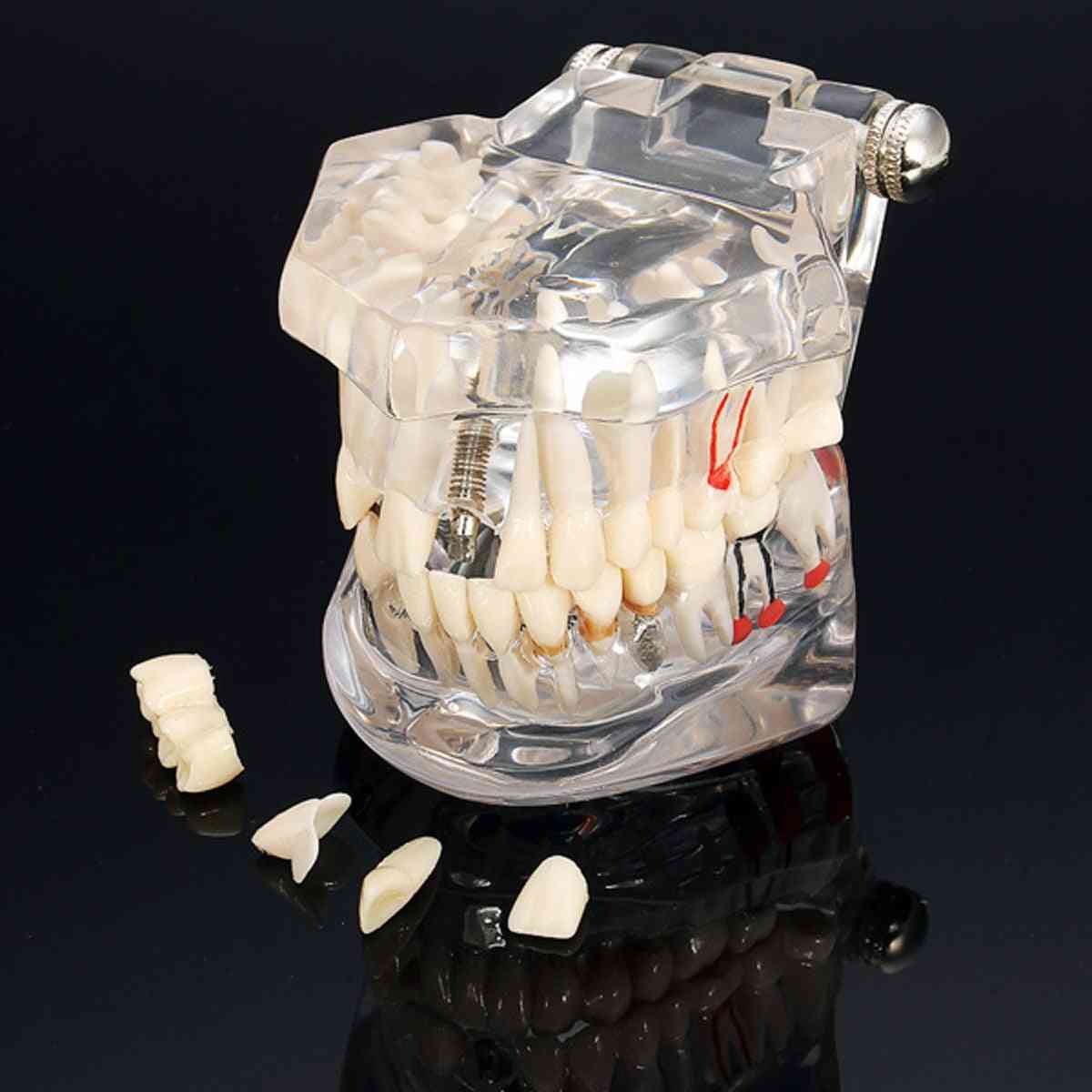 Implant Dental Disease Teeth Model With Restoration Bridge, Tooth Dentist For Medical Science,  Teaching Study Tool