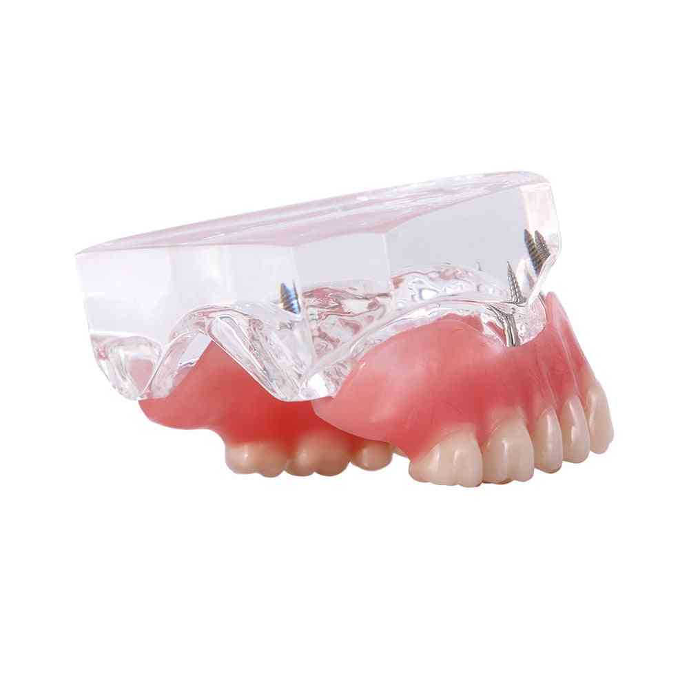 Dental Implant Restoration Teeth Model